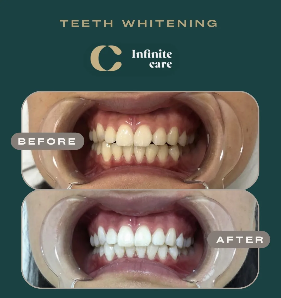Teeth whitening, before and after