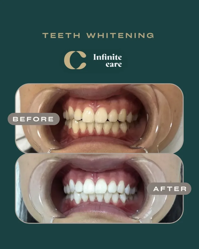 Teeth whitening